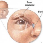 How to Cure Blocked Tear Ducts