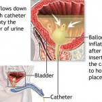 How to Identify Uropathy