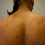 How to Banish Body Acne