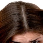 How to Overcome Dandruff Naturally