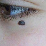 How to Remove Moles