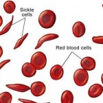 How to Test for Sickle Cell Disease