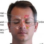 How to Get Rid of a Migraine or Sinus Headache