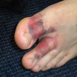 How to Treat a Broken or Sprained Toe