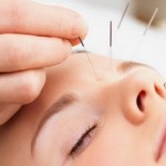 How to Do Acupuncture