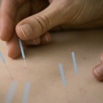 How to Treat Cellulitis with Acupuncture