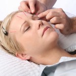 How to Treat Wrinkles with Acupuncture