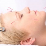 How to Use Acupuncture to Treat Hair Loss