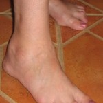 How to Help Foot Arthritis