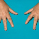 How to Spot Symptoms of Reactive Arthritis